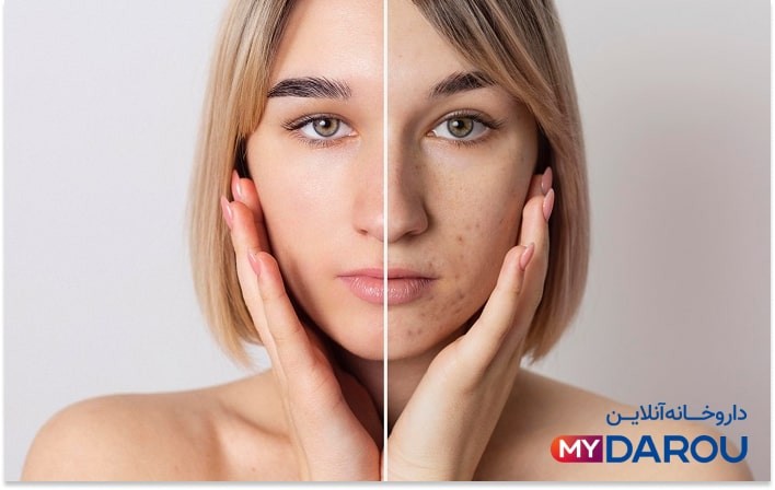 بهترین کرم ضد لک بدون بازگشت